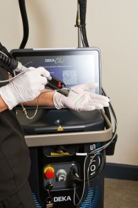 Advanced pain free laser hair removal treatment with Motus Pro in Euxton, Chorley